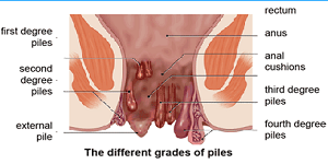 Dr.VIRENDRA KUMAR CHAUDHARY | TOP PILES & BHAGANDER DR IN ALIGARH