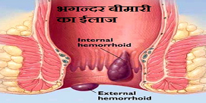 Dr.VIRENDRA KUMAR CHAUDHARY | TOP PILES & BHAGANDER DR IN ALIGARH